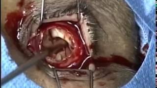 Evisceration with the placement of implant