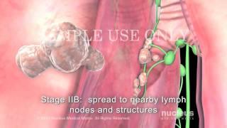 Lung Cancer Staging Non-Small Cell