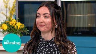 The Truth About Adult Acne: Expert Advice for Clear Skin | This Morning