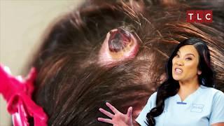 More Bumps Than Strands on Her Head! | Dr Pimple Popper TLC