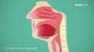Dysphagie (troubles de la déglutition) et Fausse route, qu'est-ce que c'est ?