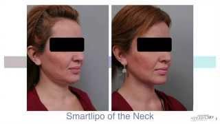 Double Chin Liposuction With Smartlipo™ | Dr. Sterry Explains