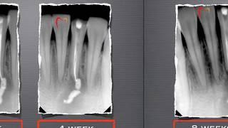 Endodontic Treatment of a Chronic Lesion