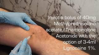 Injection Technique into the Knee Joint for OA