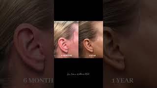 Deep Plane Facelift: Incision Line Healing #cosmeticsurgery