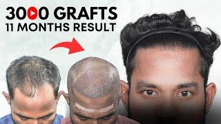 Hair Transplant in Surat | Best Results & Cost of Hair Transplant in surat