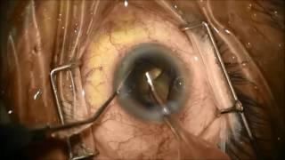 brown cataract and PXF with small pupil and phacodonesis, Dr. Hassan Adel khaled