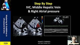 Step by Step: IVC, Hepatic vein & Right atrial pressure