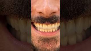 Check out this Full Mouth Reconstruction – 1-Year Recall #veneers #smilemakeover #dentist