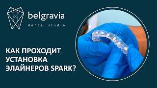   Как проходит установка элайнеров Spark?