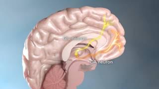 Schizophrenia Part 3 of 4 - Medical Animation by Watermark