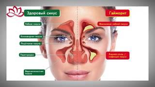 Терапевтическое лечение гайморита. ЯМИК-катетер.