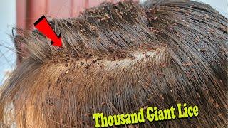 Long hair extremely damaged - Giant lice and nit removal