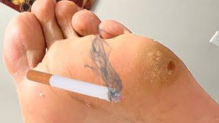 Is Smoking Causing Your Dry Skin and Painful Calluses? | Dr. Binh Healthy Feet Podiatry