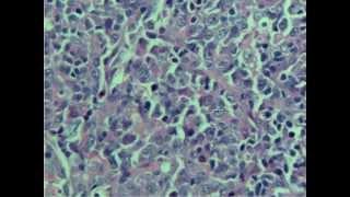 Diffuse large B-cell lymphoma