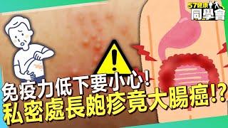 免疫力低下要小心！私密處長皰疹竟檢出大腸癌？！【 @57healthy  】#趙國翔 醫師