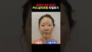 실리프팅이 2년 유지 가능? pcl 효과 장점 찐전후 #pcl #pdo #실리프팅 #리프팅시술 #전후사진 #shorts