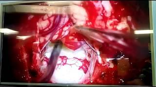 Холестеатома (опухоль) в полости IV желудочка головного мозга. Микрохирургическое удаление. ГКБ №40