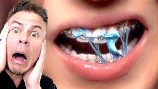 Why You Should NEVER Chew Gum With Braces