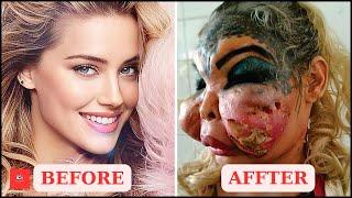 Famous Celebrities Unrecognizable After Plastic Surgery Gone Wrong | Then and Now 2024