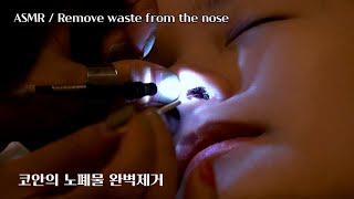 ASMR, removing waste from the nose. Cleaning the nose in China.