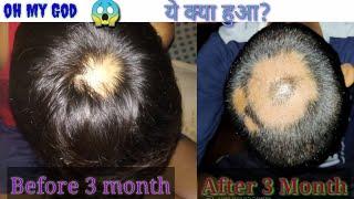 Hair Fall After 3 Month। Motivational। Sonu Kumar Mishra।