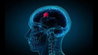 What Are Adult Brain and Spinal Cord Tumors