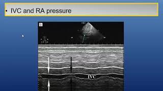 Assessment Of The Right Ventricle by ECHOcardioGRAPHY -  Dr. Hanan Hafez