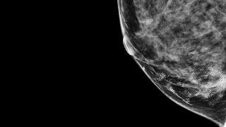 Stanford's Breast Cancer Tumor Board; Finding Answers Together