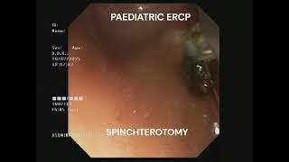 Endoscopic Removal of Bile Duct Stones in Children | Pediatric ERCP Procedure Explained #ERCP