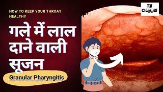 Granular pharyngitis | Gale me Lal daane hona | गले में लाल दाने वाली सूजन। गले का ख़राब रहना।