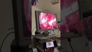 Laparoscopic cholecystectomy #bestmedicalcollegeinindia #medicaldegree