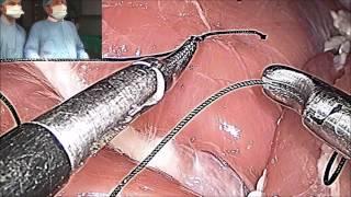 Master Class of Laparoscopic Surgeons Knot  by Dr. R.K. Mishra