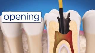 AAE Root Canal Treatment Video