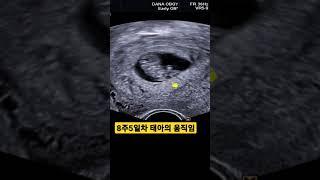 임신8주차 초음파ㅣ태아 다리 움직임