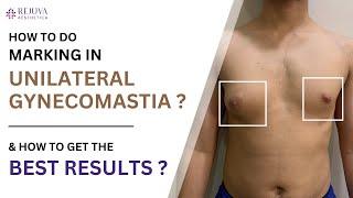 How to Do Marking in Unilateral Gynecomastia for Best Results? Explained by Dr. Arth Shah