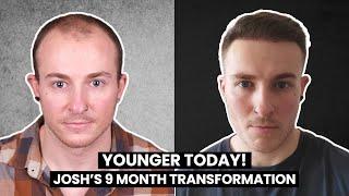 YOUNGER TODAY! Josh's 9 Month Results from Norwood V - 5! | Smile Hair Clinic