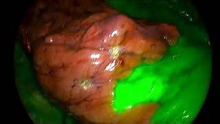 A Demonstration of VATS Segmentectomy With Near Infra-Red Imaging Technology Video 1