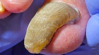 Cut The Snake Like Onychomycosis Step By Step!【Dr  Liu's Pedicur】