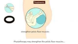 Prolapse - Causes, prevention and treatment
