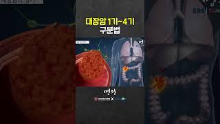 대장암 4기는 어떤 상황일까?