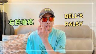 我的臉癱了，被診斷為貝爾氏麻痺（Bell's Palsy）。有人也有過這種經歷嗎？