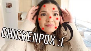 I got chickenpox :( | Chickenpox as an adult