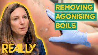 Dr. Emma Treats A Patient's Chronic Boils With A Vital Injection | The Bad Skin Clinic