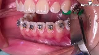 How they put braces on - 13 years old patient - Tooth Time Family Dentistry New Braunfels Texas