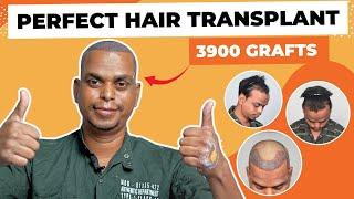 Hair Transplant in Surat | Best Results & Cost of Hair Transplant in Surat