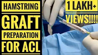 Hamstring Graft Preparation Technique for ACL