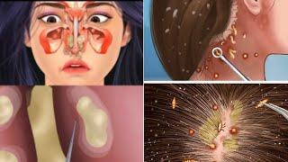 ASMR Head Lice care And Infection Nose Clean Treatment Animation.#asmr#MasterASMR