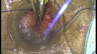 Stapled Hemorrhoidectomy for Prolapsing Hemorrhoids