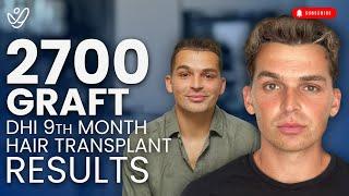 9 Month DHI Hair Transplant Results | 2700 Grafts Before and After